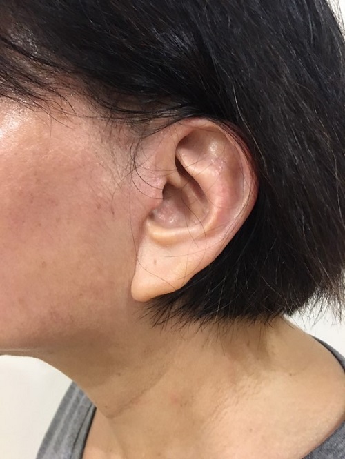 Surgical Scar and Earlobe Position 2 Surgical Scar and Earlobe Position 2